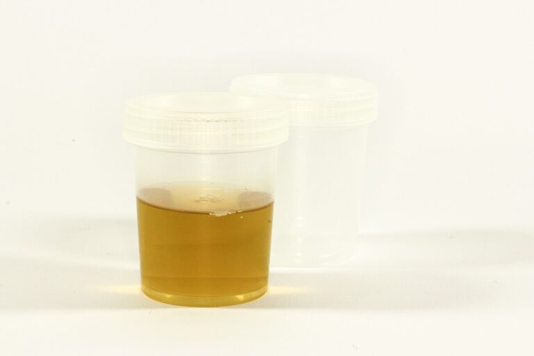 Leucociti nelle urine cause, quando preoccuparsi e come si curano