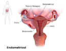 Endometriosi: cos'è, cause, sintomi, cure e trattamenti