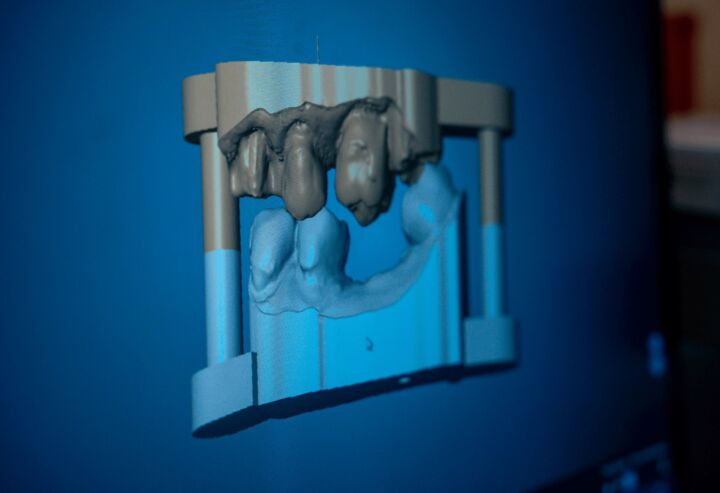 Rigenerazione ossea dentale: una soluzione sicura per la salute della bocca